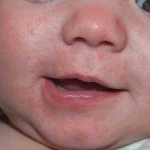 Izpuščaji okoli ust otroka: razlogi za videz