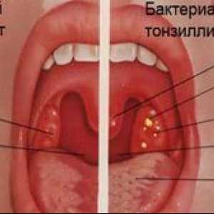 Tonsilitis: znaki, simptomi, zdravljenje