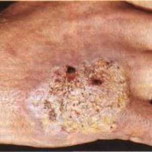 Tuberkuloza kože: vrste, simptomi, vizualne slike