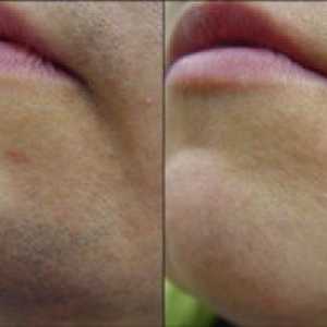 Odstranjevanje neželene obrazne dlake z laserjem