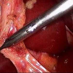 Odstranjevanje žolčnika: video operacije laparoskopija