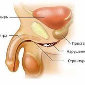 Urethritis pri moških: simptomi in zdravljenje