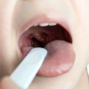 Povečana tonzila pri otroku: zdravljenje, fotografija