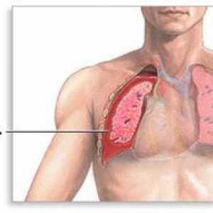 Voda v pljučih: vzroki, posledice, zdravljenje