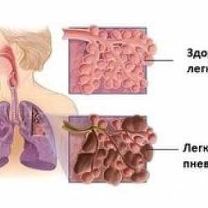 Vse o pljučni fibrozi: kako zdraviti fibrozne spremembe v pljučih