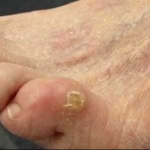 Bolezni stopal stopal: kako pozdraviti suhe kaluse